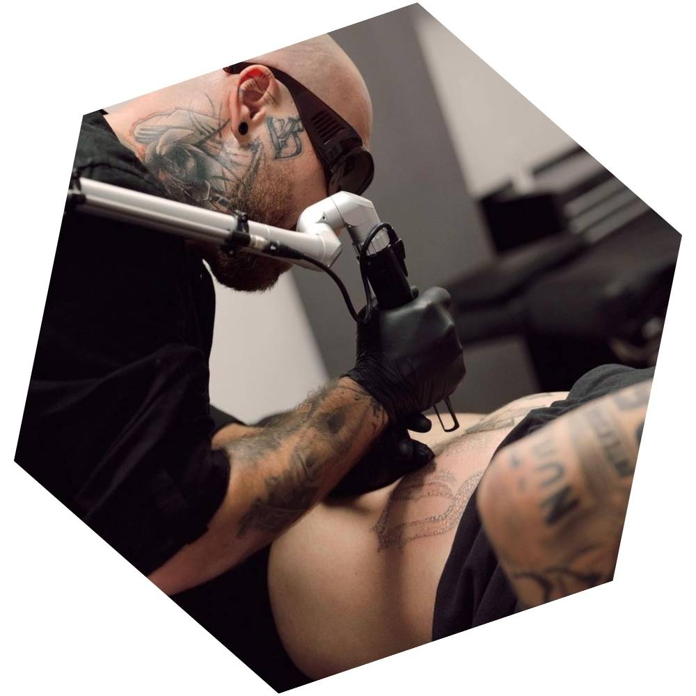 eliminación de tatuajes en torrent valencia