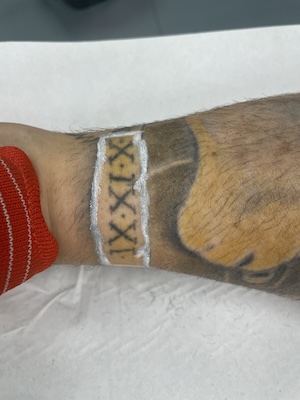Eliminación de tatuajes láser blankout fecha pierna antes