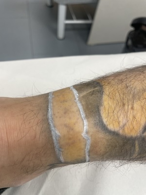 Eliminación de tatuajes láser blankout fecha sesión 4