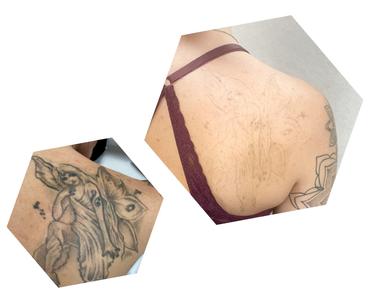 eliminación láser blankout borrar tatuaje